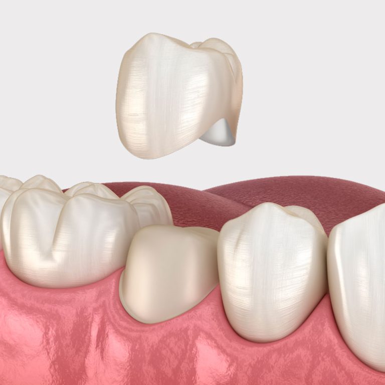 keramicheskaya-koronka