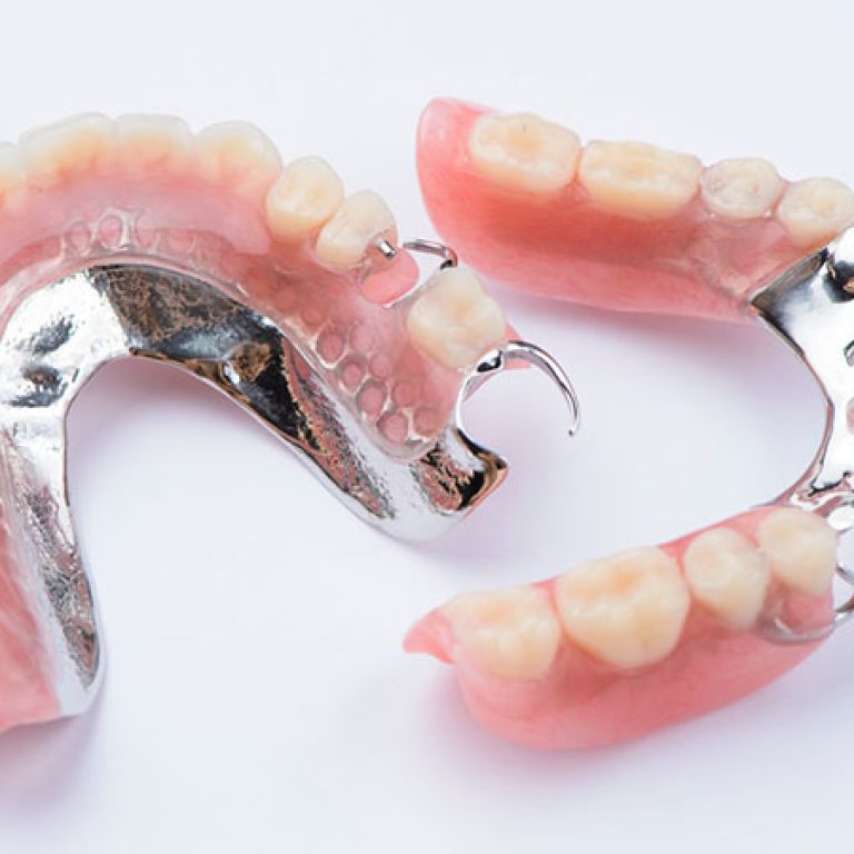 protezirovanie-zubov-vidy-i-ceny