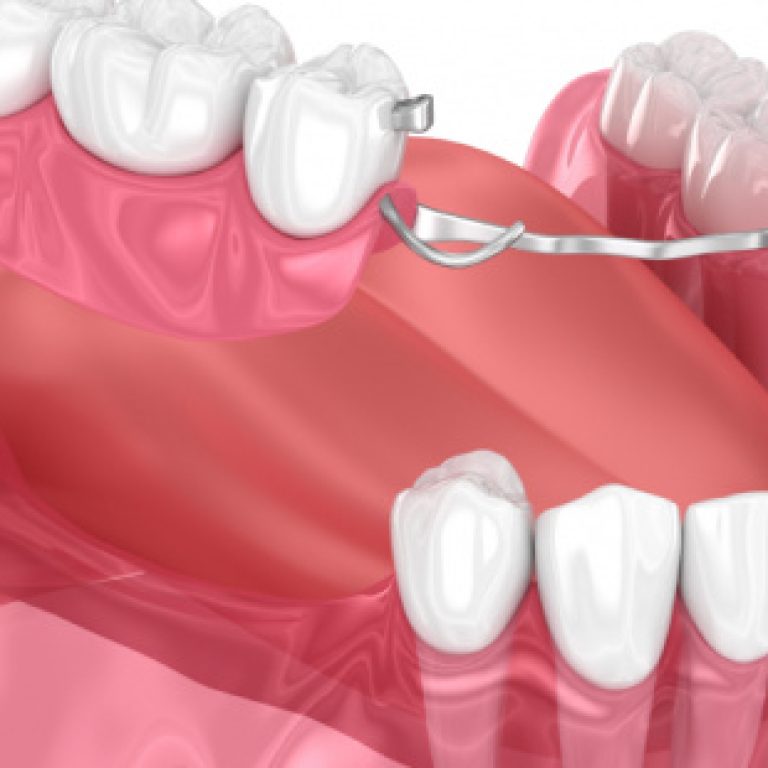 semnyj_byugelnyj_protez_zubov