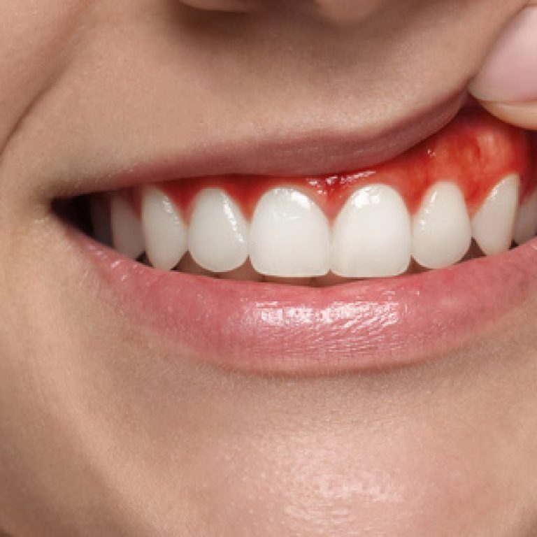 Лечение гингивита