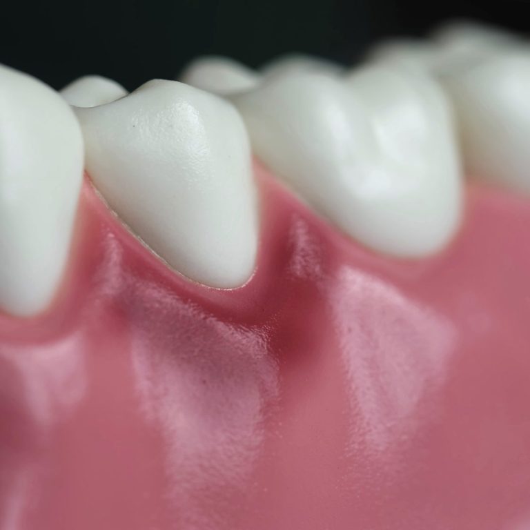 Лечение десен