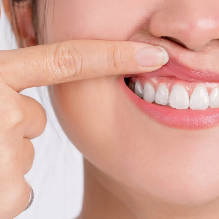 Лечение пародонтоза