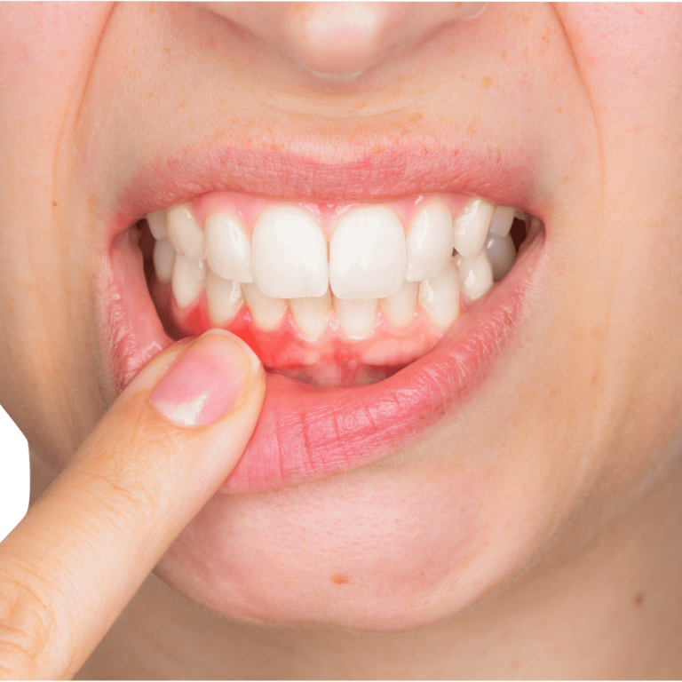 Лечение пародонтоза